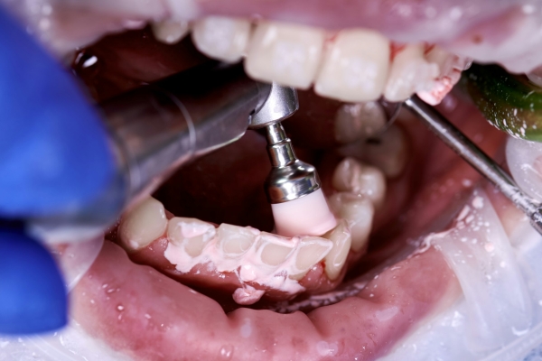 Doctor cleaning and polishing patient teeth in dental clinic.