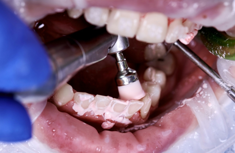 Doctor cleaning and polishing patient teeth in dental clinic.