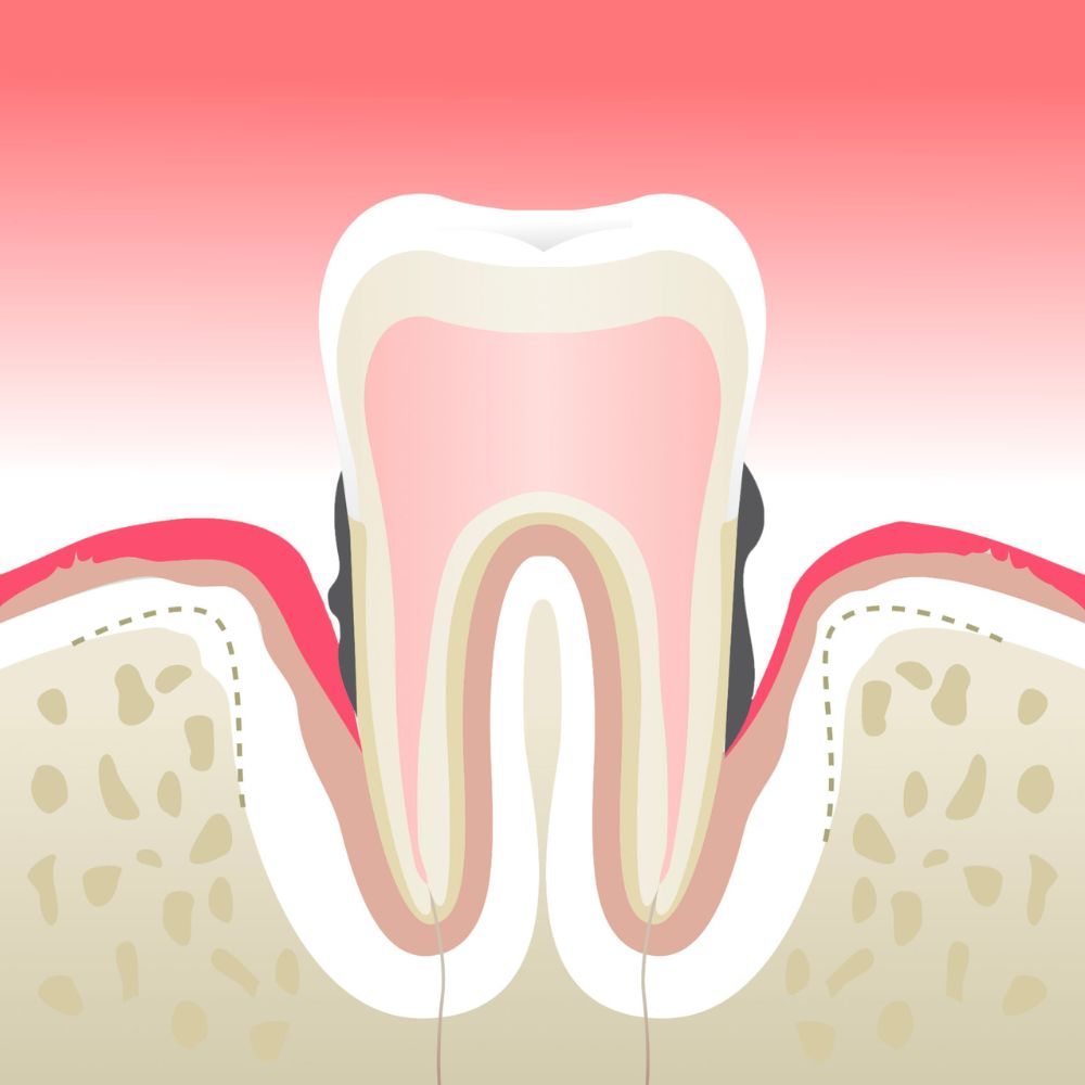 parodontite